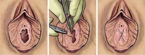 operación de himenoplastia