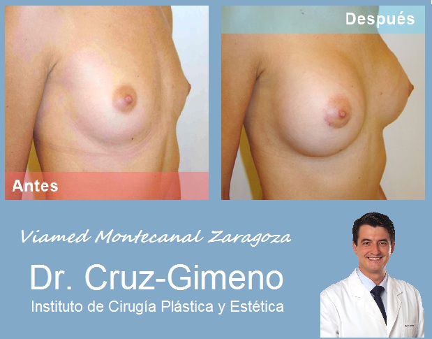 Logo INSTITUTO DE CIRUGIA PLASTICA Y ESTETICA Dr CRUZ-GIMENO