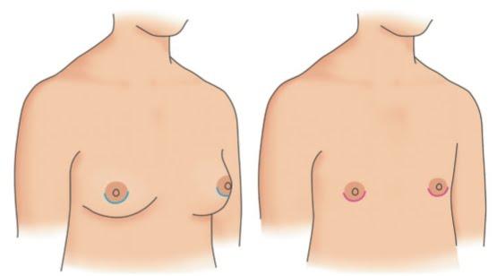 Mastectomía bilateral: ¿Qué es y por qué es cada vez más solicitada?