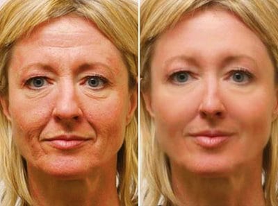 Cirugia de LIFTING facial