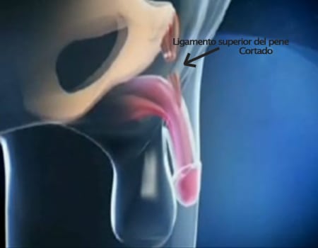 Faloplastia o peneplastia: Cirugía de Alargamiento y Engrosamiento del pene