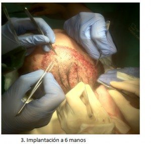Implantacion de foliculos en transplante