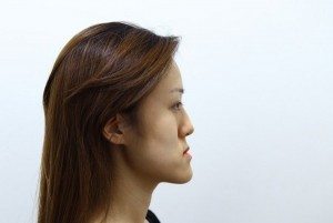 Gemelas-coreanas-feas-transformadas-en-lindas-por-cirugias-esteticas-3