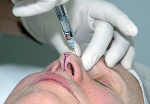 Rinomodelación: Remodelar la nariz sin cirugía