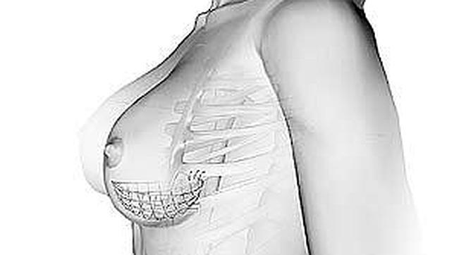 Sostén interno, lo nuevo en cirugías mamarias