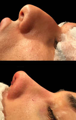 Rinoplastia