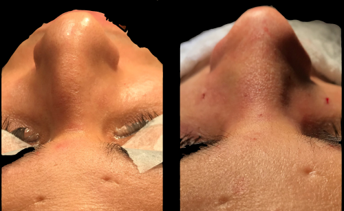 Rinoplastia