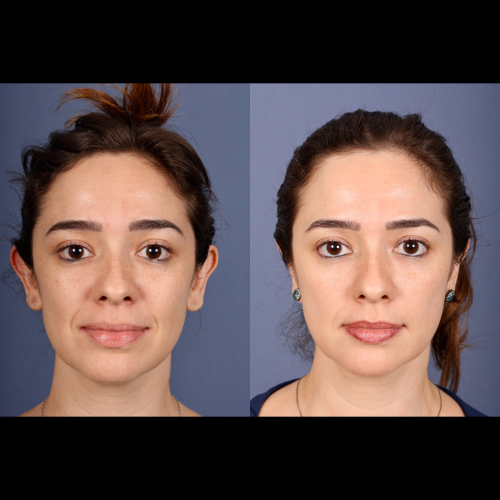 Otoplastia