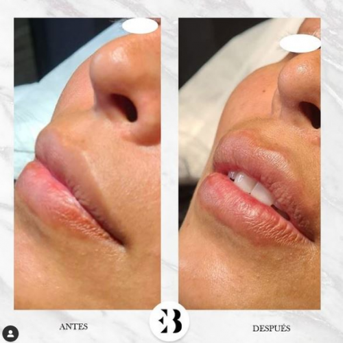 Aumento de labios