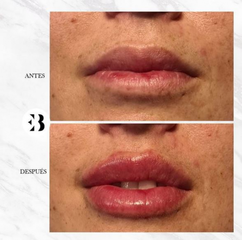 Aumento de labios