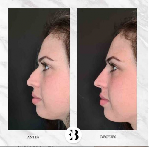 Rinomodelaci�n sin cirug�a