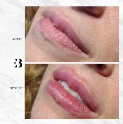Aumento de labios