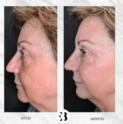 aumento de p�mulos