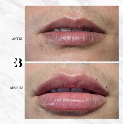 Aumento de labios