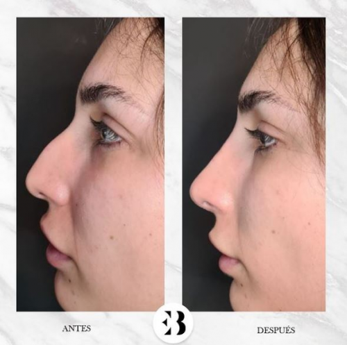 Rinomodelaci�n sin cirug�a