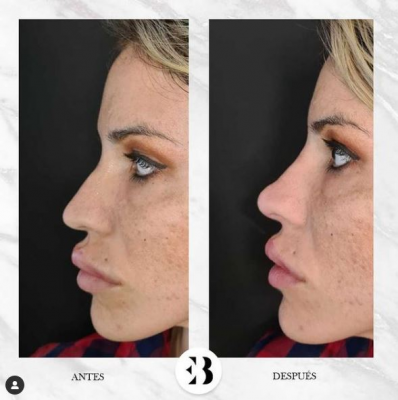 Rinomodelaci�n sin cirug�a