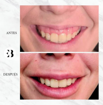 Eliminar sonrisa gingival