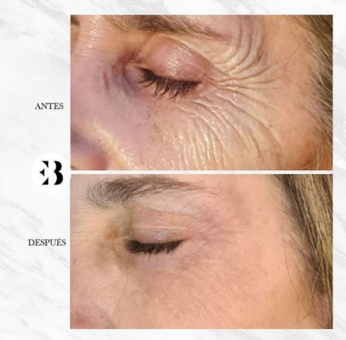 rejuvenecimiento facial  plexr pro