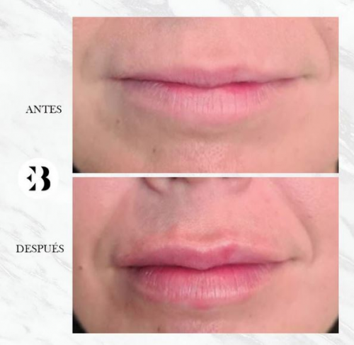 Aumento de labios