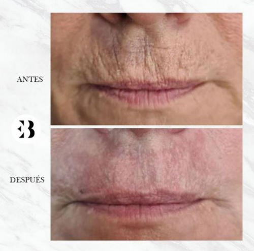 rejuvenecimiento facial  plexr pro