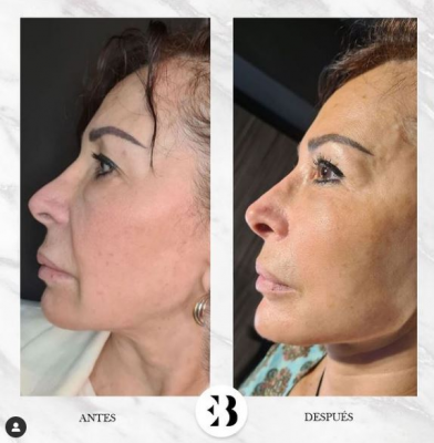 Rinomodelaci�n sin cirug�a