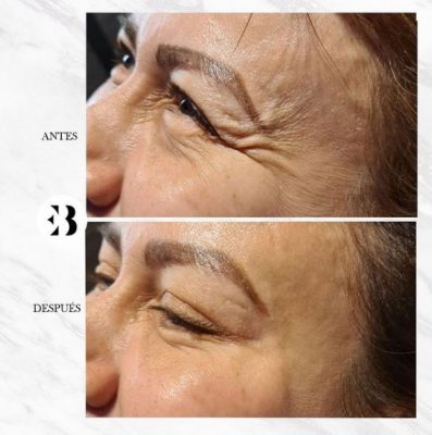 Eliminar patas de gallo