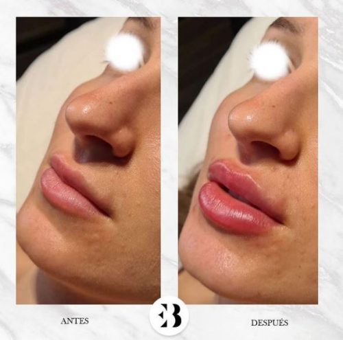 Aumento de labios