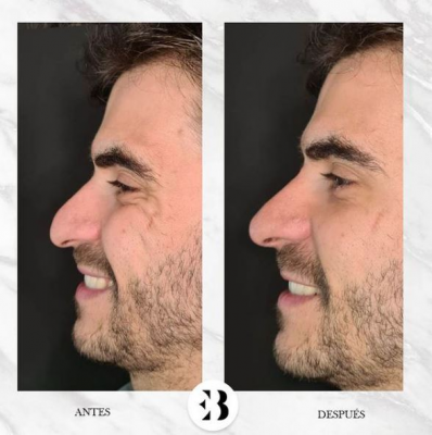 Rinomodelaci�n sin cirug�a