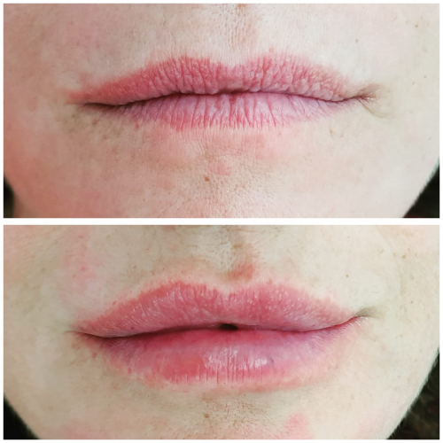 �cido hialur�nico