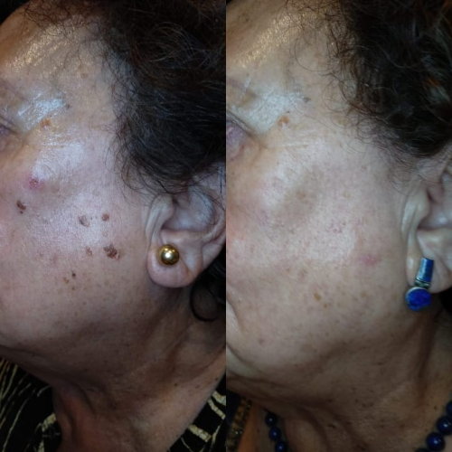 L�ser CO2 Facial