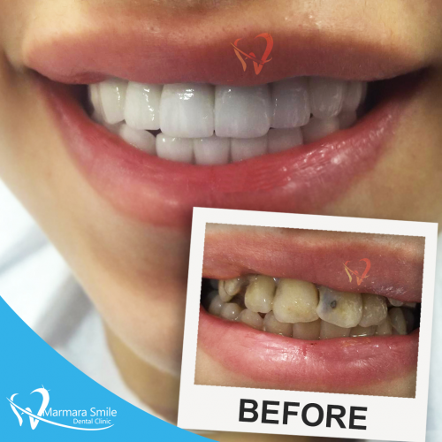 Hollywood-Smile-Before-After-Women-2