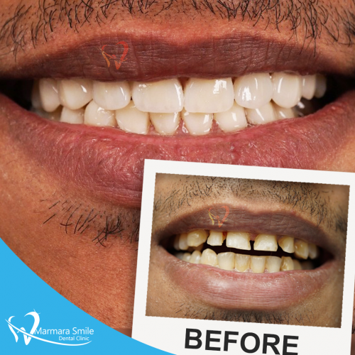 Hollywood-Smile-Before-After-Men-3