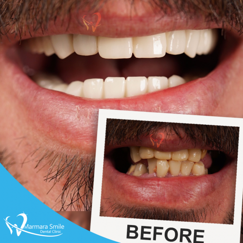 Hollywood-Smile-Before-After-Men-2