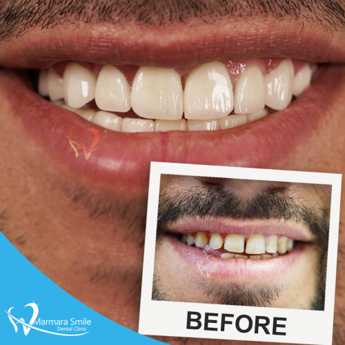 Hollywood-Smile-Before-After-Men-1