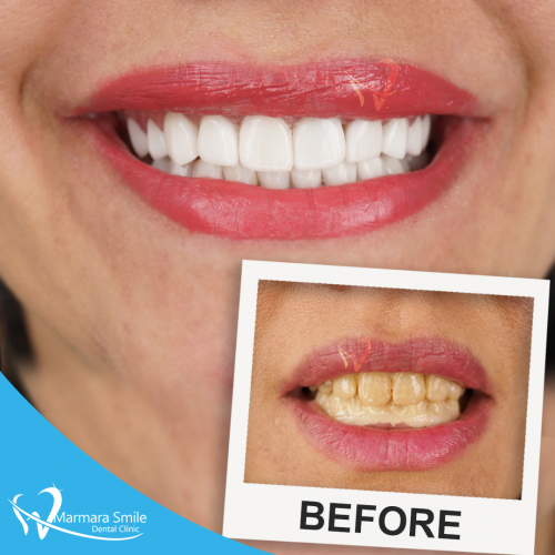 Hollywood-Smile-Before-After-Women-1