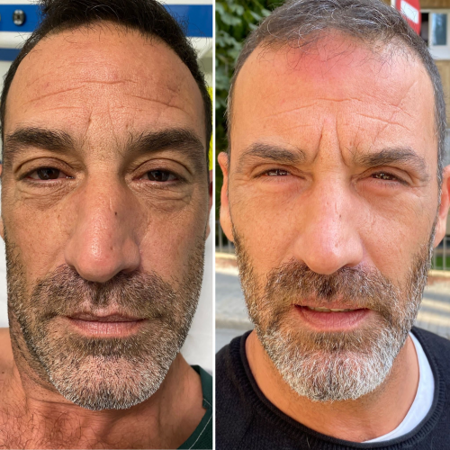 Minilifting Facial Hombres