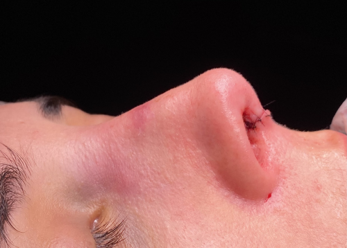 Rinoplastia ultras�nica