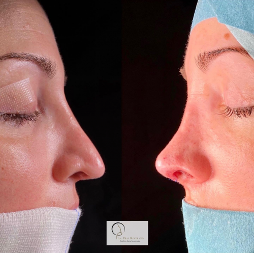 Rinoplastia ultras�nica