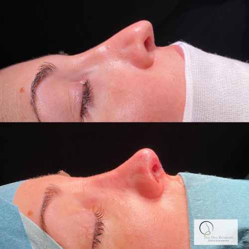Rinoplastia ultras�nica