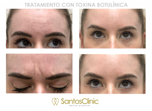 TOXINA BOTUL�NICA