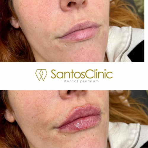 AUMENTO DE LABIOS