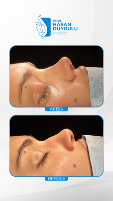 Foto Face Aesthetics Turkey | Hasan Duygulu MD