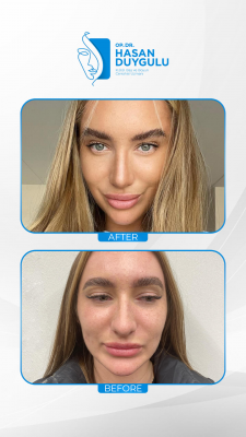 Foto Face Aesthetics Turkey | Hasan Duygulu MD
