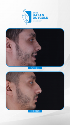 Foto Face Aesthetics Turkey | Hasan Duygulu MD