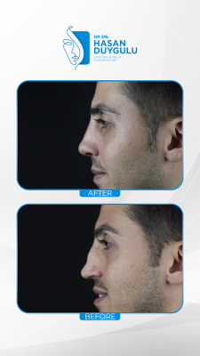 Foto Face Aesthetics Turkey | Hasan Duygulu MD