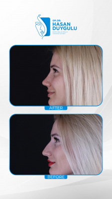Foto Face Aesthetics Turkey | Hasan Duygulu MD
