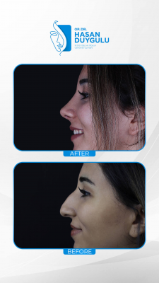 Foto Face Aesthetics Turkey | Hasan Duygulu MD