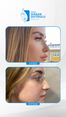 Foto Face Aesthetics Turkey | Hasan Duygulu MD
