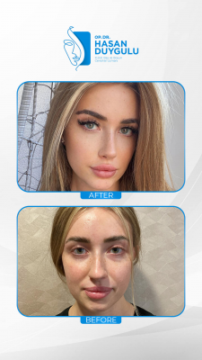 Foto Face Aesthetics Turkey | Hasan Duygulu MD
