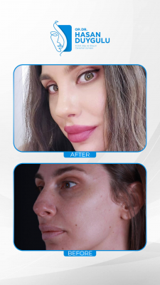 Foto Face Aesthetics Turkey | Hasan Duygulu MD